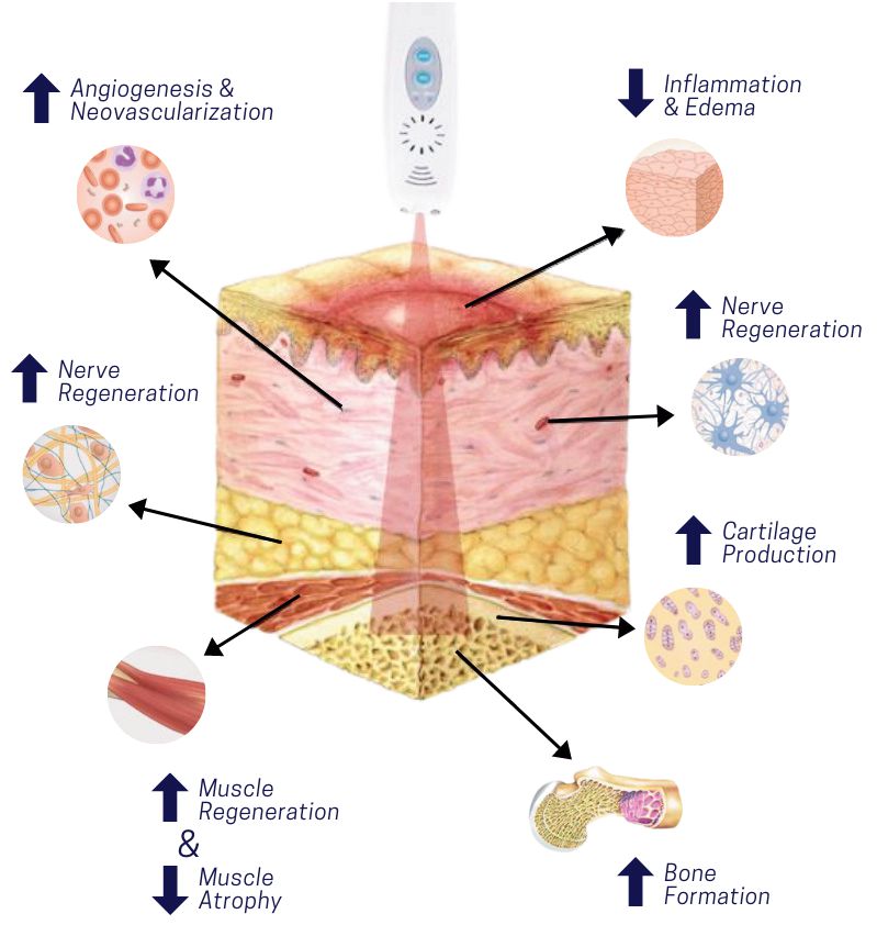 High Power Laser Therapy